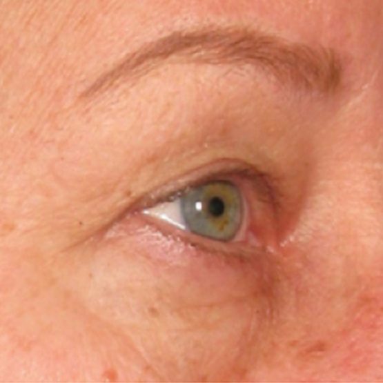 Ultherapy øjenbrynsløft efter